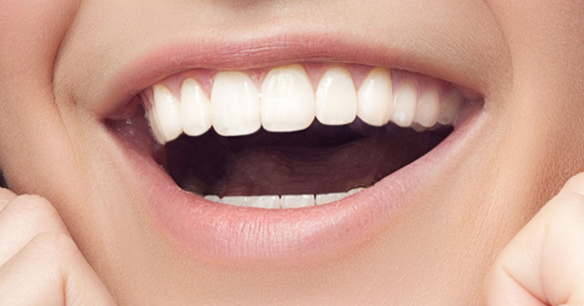 Mona Goodarzi DDS - The Truth About Teeth Whitening Treatments Blog