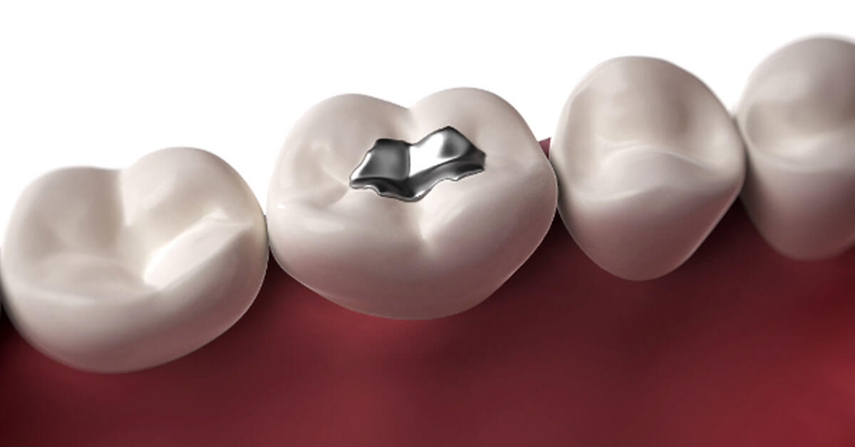 Mona Goodarzi DDS - Out With The Old… In With The New | Amalgam Vs Tooth Coloured Fillings Blog